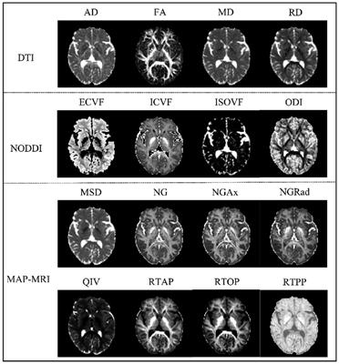 Assessing brain microstructural changes in chronic kidney disease: a diffusion imaging study using multiple models